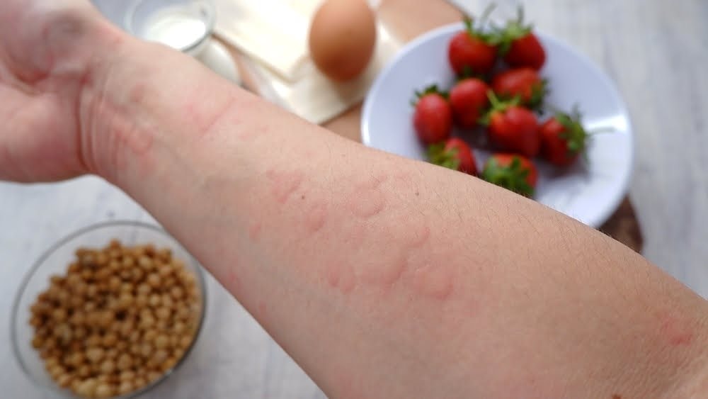 food-allergy-hives-skin-rashes.jpg