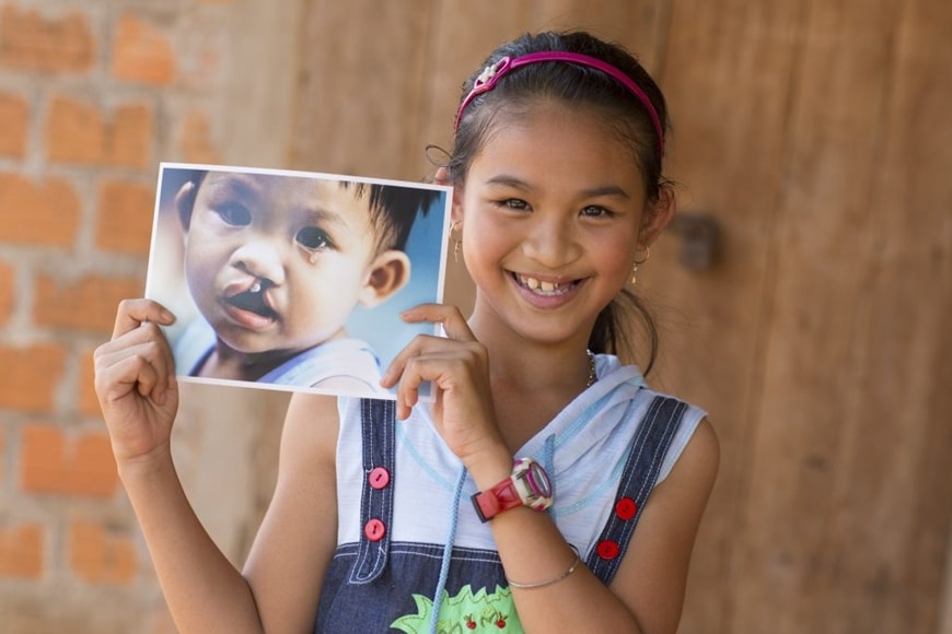 Vietnam Airlines quyên góp dặm bay, hỗ trợ phẫu thuật cho trẻ em